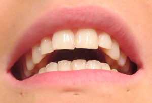 My teeth after using it - artificial light